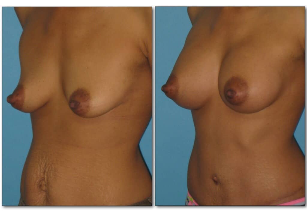 Before and after mommy makeover showing breast rejuvenation and tummy tuck results.