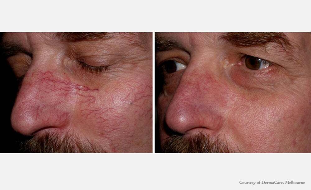Before and after spider vein treatment on man’s face showing reduced redness and veins.