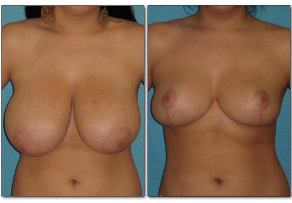 Before and after breast cosmetic procedures showing reduced size and improved shape for balanced proportions.