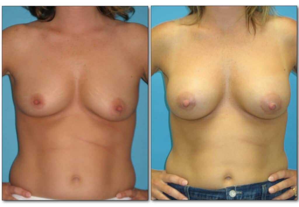 BREAST page 4