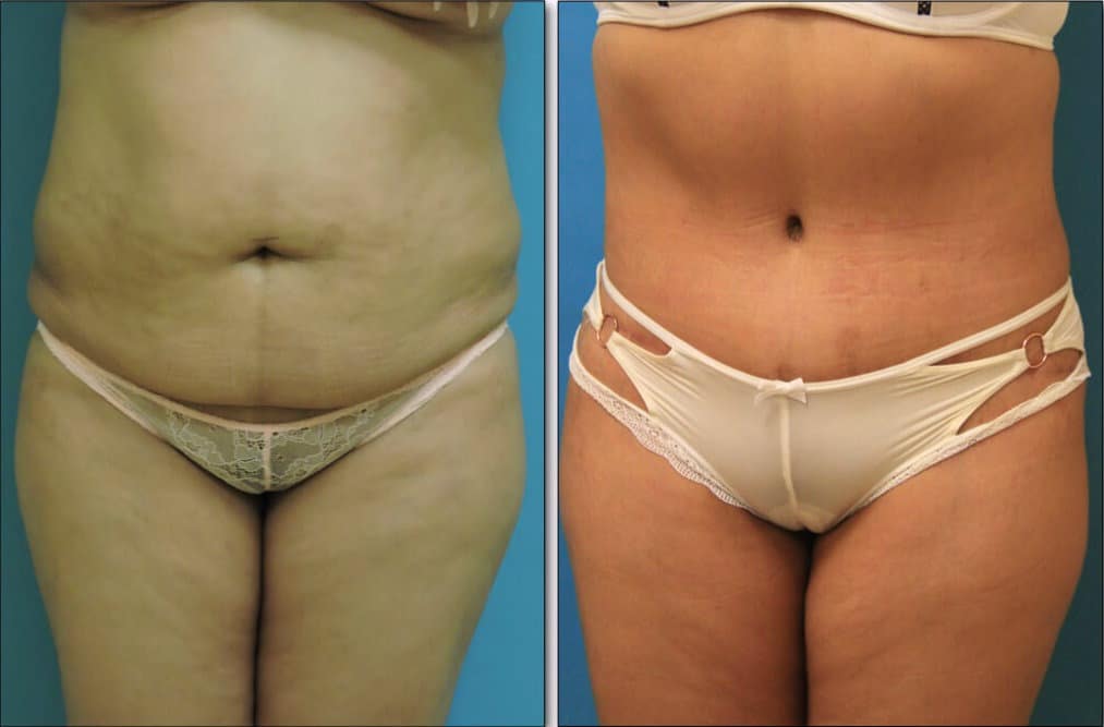 abdominoplasty-tummy banner-1