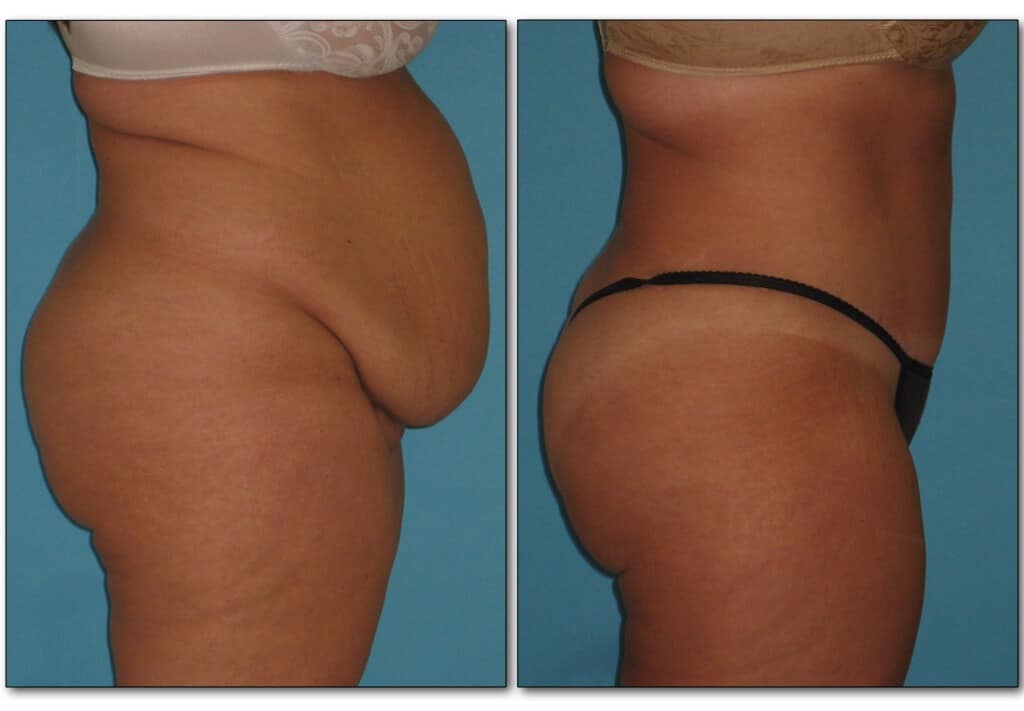 abdominoplasty-tummy page 1