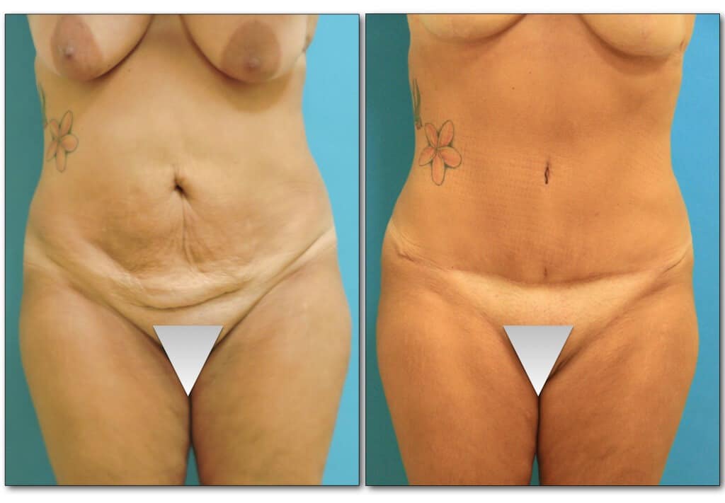abdominoplasty-tummy page 2