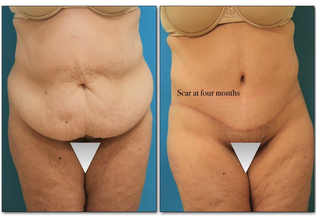 abdominoplasty-tummy page-3