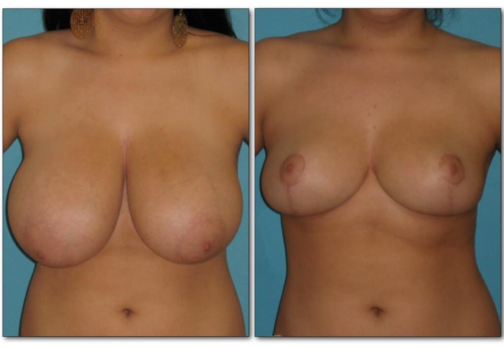 Before and after cosmetic breast reduction showing smaller, lifted breast shape in woman with large breasts.