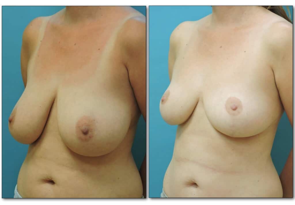 Before and after cosmetic breast reduction showing lifted, proportional breast size and improved contour.