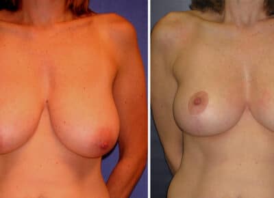 Breast Procedure Patient – 6