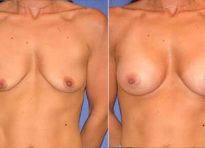 Breast Augmentation Patient – 11