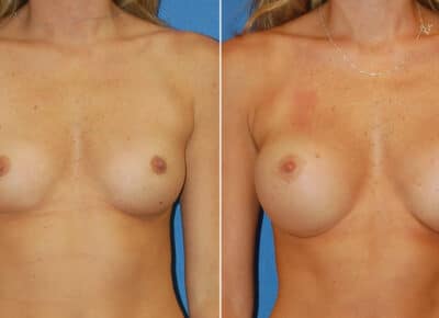 Breast Augmentation Patient
