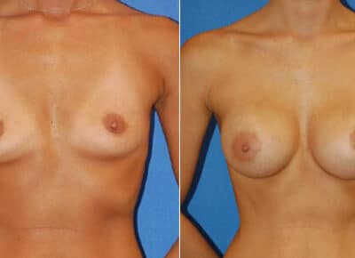 Breast Augmentation Patient – 3