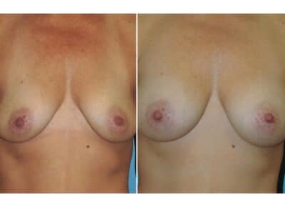 Breast Augmentation Patient – 15