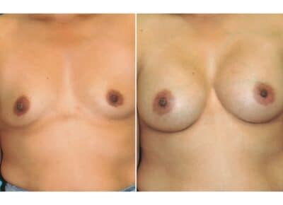 Breast Augmentation Patient – 18