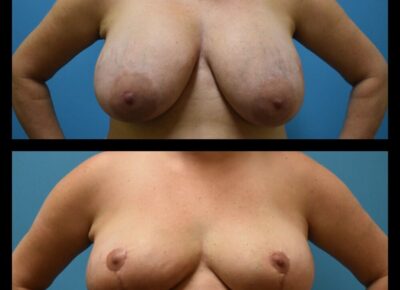 Breast Reduction – Zeiderman 1
