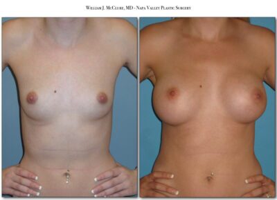 Breast Augmentation – Dr. McClure 1