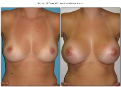 Breast Augmentation – Dr. McClure 2
