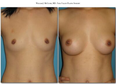 Breast Augmentation – Dr. McClure 4