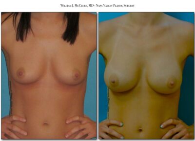 Breast Augmentation – Dr. McClure 5