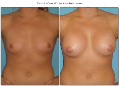 Breast Augmentation – Dr. McClure 6