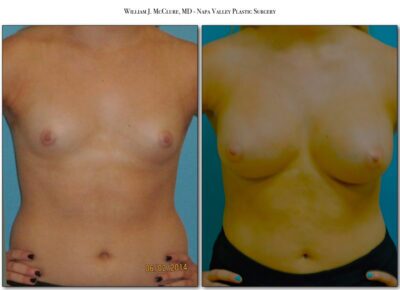 Breast Augmentation – Dr. McClure 7