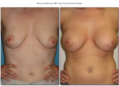 Breast Augmentation – Dr. McClure 9