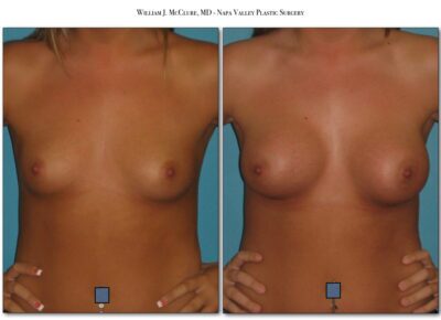 Breast Augmentation – Dr. McClure 12