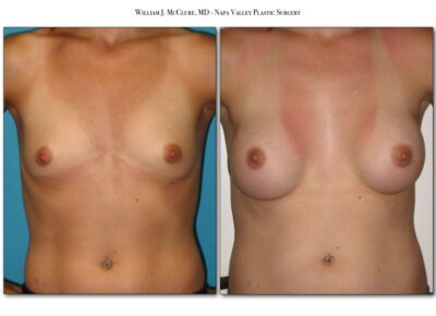 Breast Augmentation – Dr. McClure 13