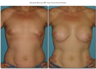 Breast Augmentation – Dr. McClure 14