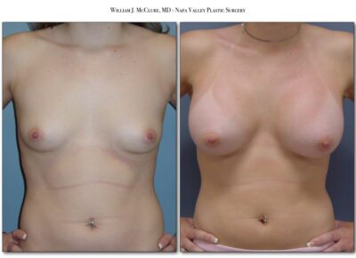 Breast Augmentation – Dr. McClure 15