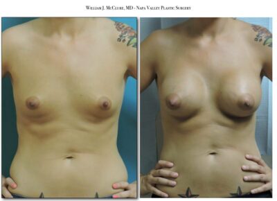 Breast Augmentation – Dr. McClure 16