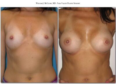 Breast Augmentation – Dr. McClure 17