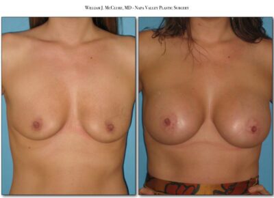 Breast Augmentation – Dr. McClure 18