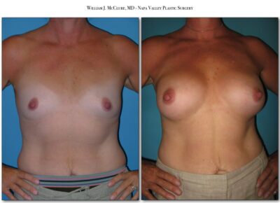 Breast Augmentation – Dr. McClure 20