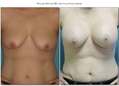 Breast Augmentation – Dr. McClure 21