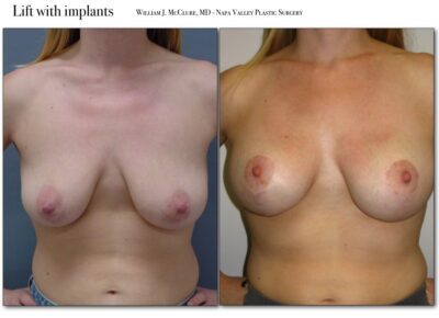 Breast Reduction – Dr. McClure 13