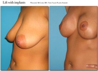 Breast Reduction – Dr. McClure 1