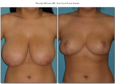 Breast Reduction – Dr. McClure 9