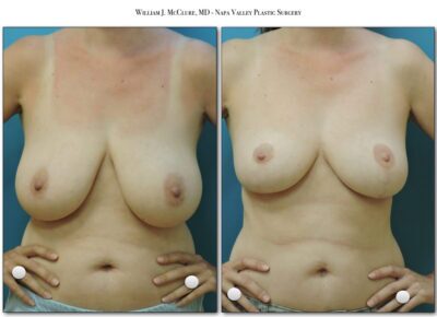 Breast Reduction – Dr. McClure 14