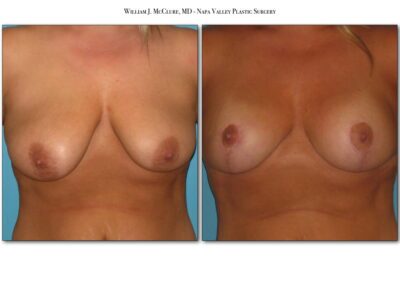 Breast Reduction – Dr. McClure 5