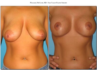 Breast Reduction – Dr. McClure 4