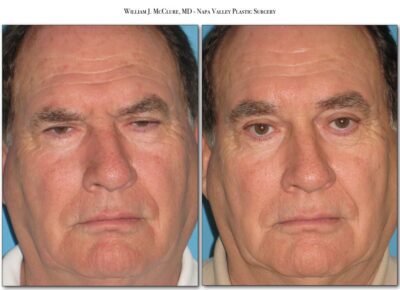 Browlift – Dr. McClure 30