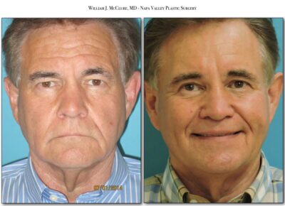 Browlift – Dr. McClure 31