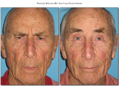 Browlift – Dr. McClure 33