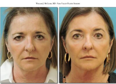Browlift – Dr. McClure 9