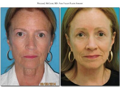 Browlift – Dr. McClure 13