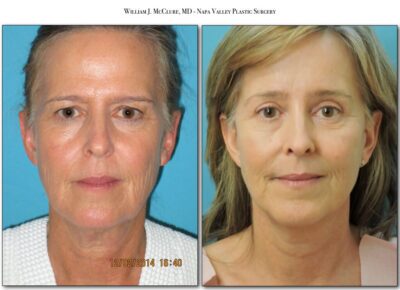 Browlift – Dr. McClure 15