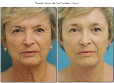 Browlift – Dr. McClure 6