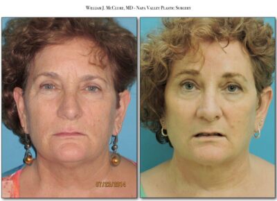 Browlift – Dr. McClure 17