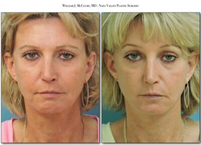 Browlift – Dr. McClure 21