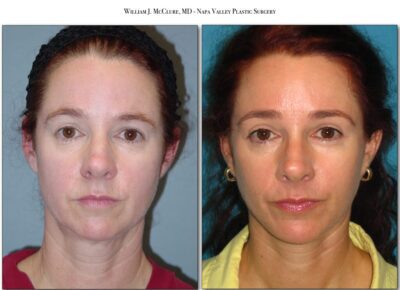 Browlift – Dr. McClure 27