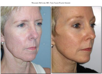 Browlift – Dr. McClure 28